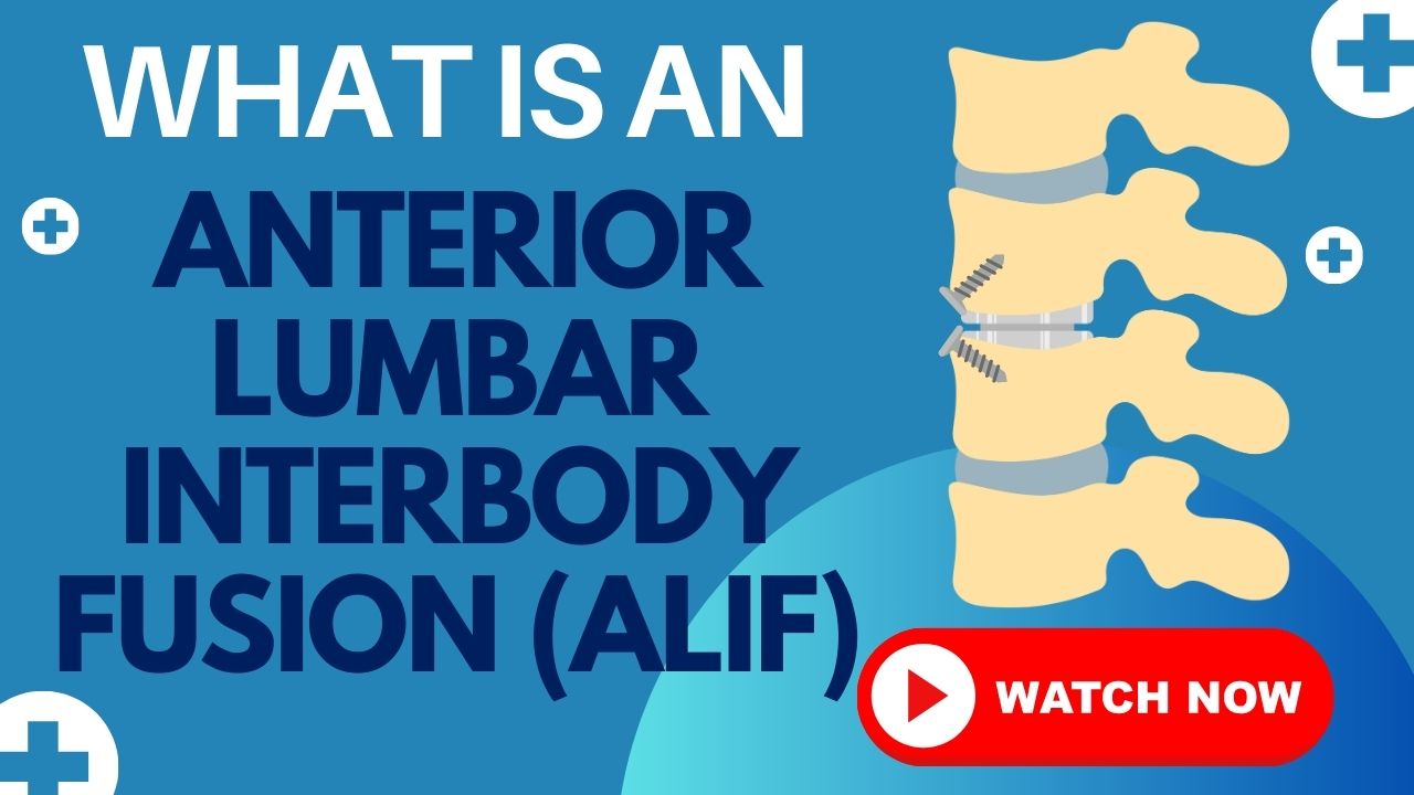 Anterior Lumbar Interbody Fusion (ALIF)