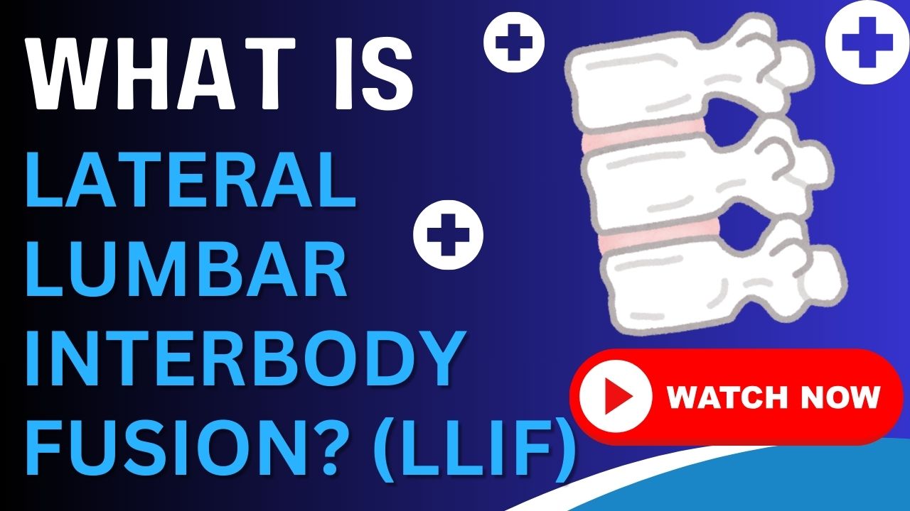 Lateral Lumbar Interbody Fusion (LLIF)