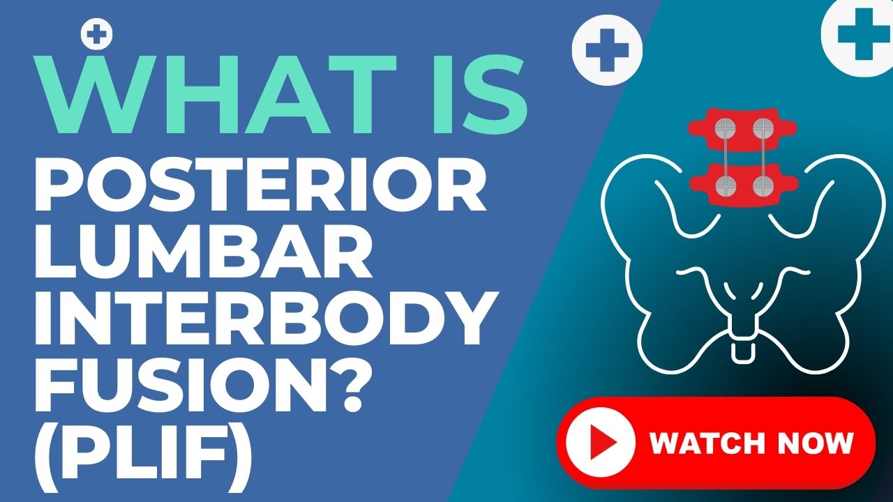 Posterior Lumbar Interbody Fusion (PLIF)